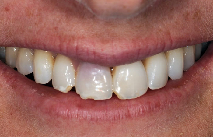 How To Fix A Chipped Tooth Or A Broken Tooth Causes Treatment 